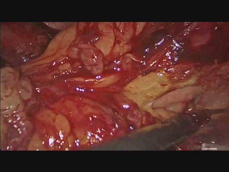 Pancréatectomie distale par laparoscopie pour lésion métastatique rare dans le pancréas