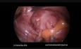 L'appendicectomie par voie laparoscopique et le nouage intracorporel