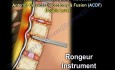 Colonne cervicale - décompression et fusion