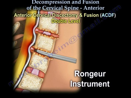 Colonne cervicale - décompression et fusion