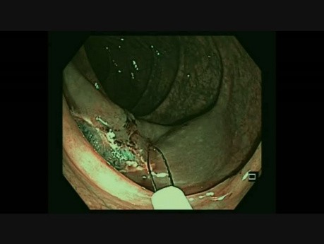 Polype du côlon ascendant avec dépression centrale, polypectomie