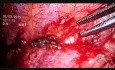 Pleurectomie VTS et résection cunéiforme du lobe supérieur gauche