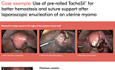 Utilisation de TachoSil® Pré-Enroulé pour une Meilleure Hémostase et un Meilleur Maintien des Sutures Après l'Enucléation Laparoscopique d'un Fibrome Utérin