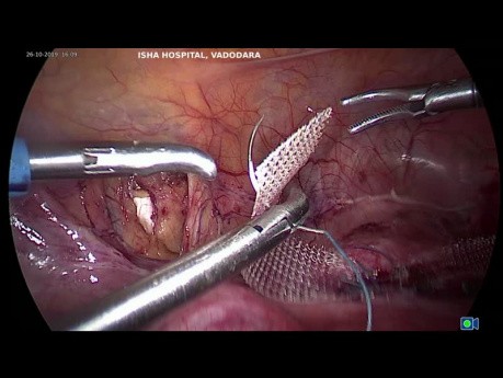 Hystéropexie laparoscopique pour un prolapsus apical