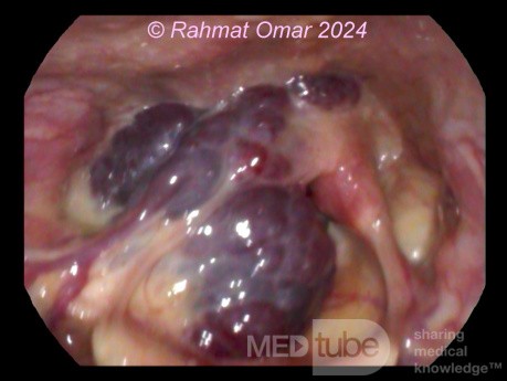 Hémangiome Laryngé Chez Un Adulte