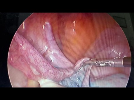 Chirurgie Coelioscopique de l'Obstruction de la Trompe de Fallope Gauche