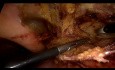 Laparoscopique Transabdominale Prépéritonéale Chirurgie après Laparoscopique Totalement Extra-Péritonéale