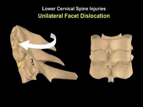 Lésions du rachis cervical - Fractures 