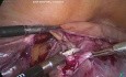 OT solide post-hystérectomie dans le sac Nila