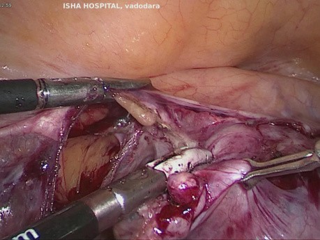 OT solide post-hystérectomie dans le sac Nila