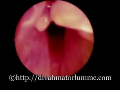 Lésions Laryngées Post-Intubation 