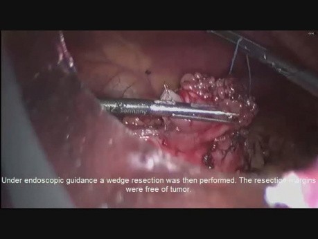 Opération combiné laparoscopique et endoscopique de résection en coin d'une tumeur carcinoïde gastrique