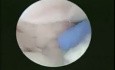 Vue Arthroscopique d'une Fracture Articulaire du Radius Distal