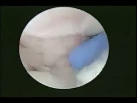 Vue Arthroscopique d'une Fracture Articulaire du Radius Distal