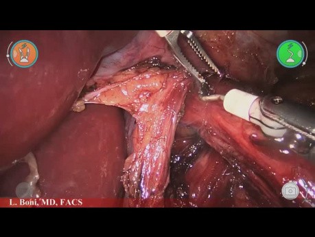 Toupet Fundoplication with Versius – L. Boni