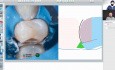Which is the Best Matrix System for Class II Restorations