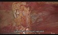 Réparation de la hernie ombilicale en utilisant la technique e-TEP avec pose d'un filet 