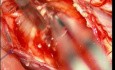 Tumeur Intramédullaire de la Moelle Epinière Cervicale - Excision Microchirurgicale
