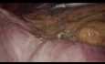 Hémicolectomie laparoscopique droite avec anastomose intracorporelle