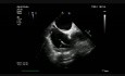 Thrombus sur une sonde d'un stimulateur cardiaque