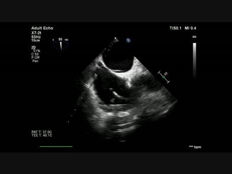 Thrombus sur une sonde d'un stimulateur cardiaque