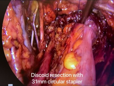 Résection discoidale avec hystérectomie pour l'endométriose profonde.