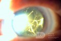 Cataracte traumatique négligée et hyphéma ancien