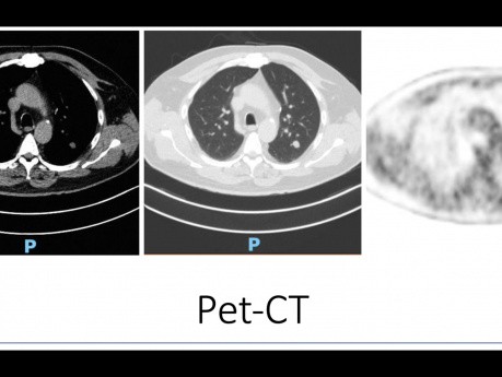 Segmentectomie pulmonaire S2, lobe supérieur gauche