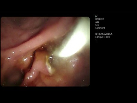 L'ERCP avec prothèses auto-expansibles (SEMS) dans le traitemet palliatif de cancer du pancréas avancé.