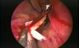 Septoplastie endoscopique