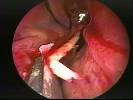 Septoplastie endoscopique