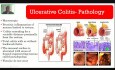 Maladie inflammatoire chronique de l'intestin - hémorragie gastro-intestinale basse