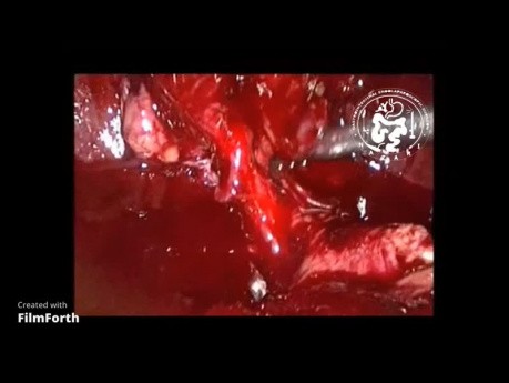 Cholécystectomie laparoscopique dans la cholécystite aiguë