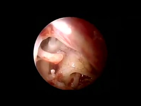Stapédotomie Endoscopique pour Otospongiose