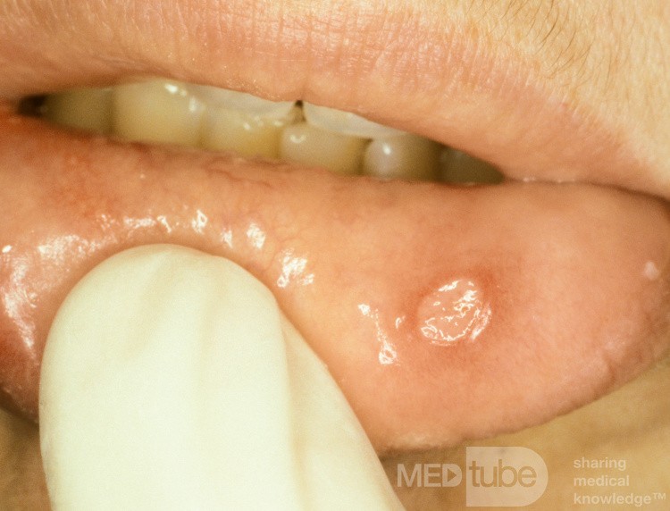 Aphte à l'intérieur de la lèvre inférieure • Image • Site médical ...