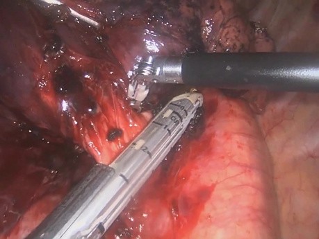 Left Lower Lobectomy with Versius – Patrick Bagan