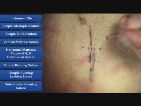 Le cours de la suture