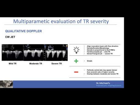 Évaluation Echographique de la Régurgitation Tricuspidienne – Mécanisme, Quantification et Sélection du Matériel