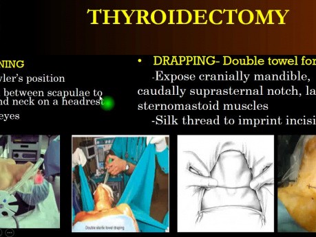 Thyroïdectomie