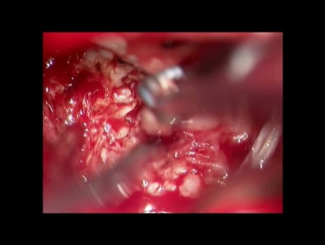 Neurinome acoustique intra-extrameatal