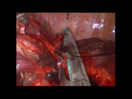 Segmentectomie anatomique supérieure gauche S2+S4-5 par chirurgie thoracique vidéo-assistée (CTVA) à l'incision unique