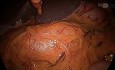 Colectomie Droite Laparoscopique avec Contrôle Vasculaire CME