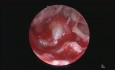 Chirurgie endoscopique de l'oreille du cholestéatome