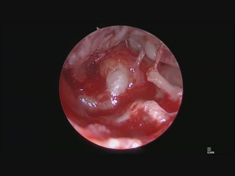 Chirurgie endoscopique de l'oreille du cholestéatome