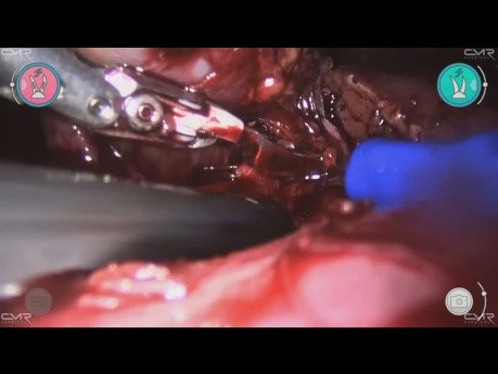 Focus sur la néphrectomie partielle robot-assistée avec Versius
