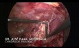 Résection laparoscopique d'un gros kyste péritonéal