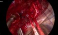Résection Trachéale Vidéo-Assistée Uniportale avec Reconstruction Partielle de la Carène (Sans Intubation)