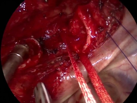 Résection Trachéale Vidéo-Assistée Uniportale avec Reconstruction Partielle de la Carène (Sans Intubation)