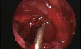 Technique de Caldwell-Luc - Opération endoscopique du sinus maxillaire