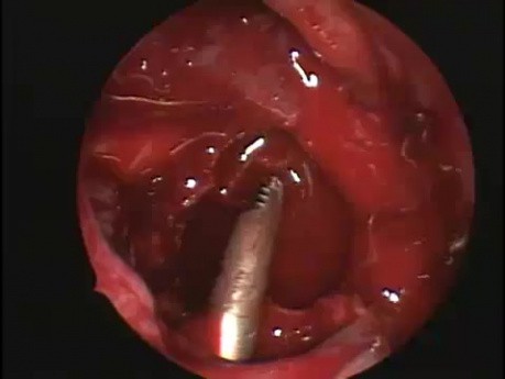 Technique de Caldwell-Luc - Opération endoscopique du sinus maxillaire